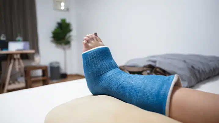 Fracture Care Treatment, Ankle in blue cast, resting on pillow