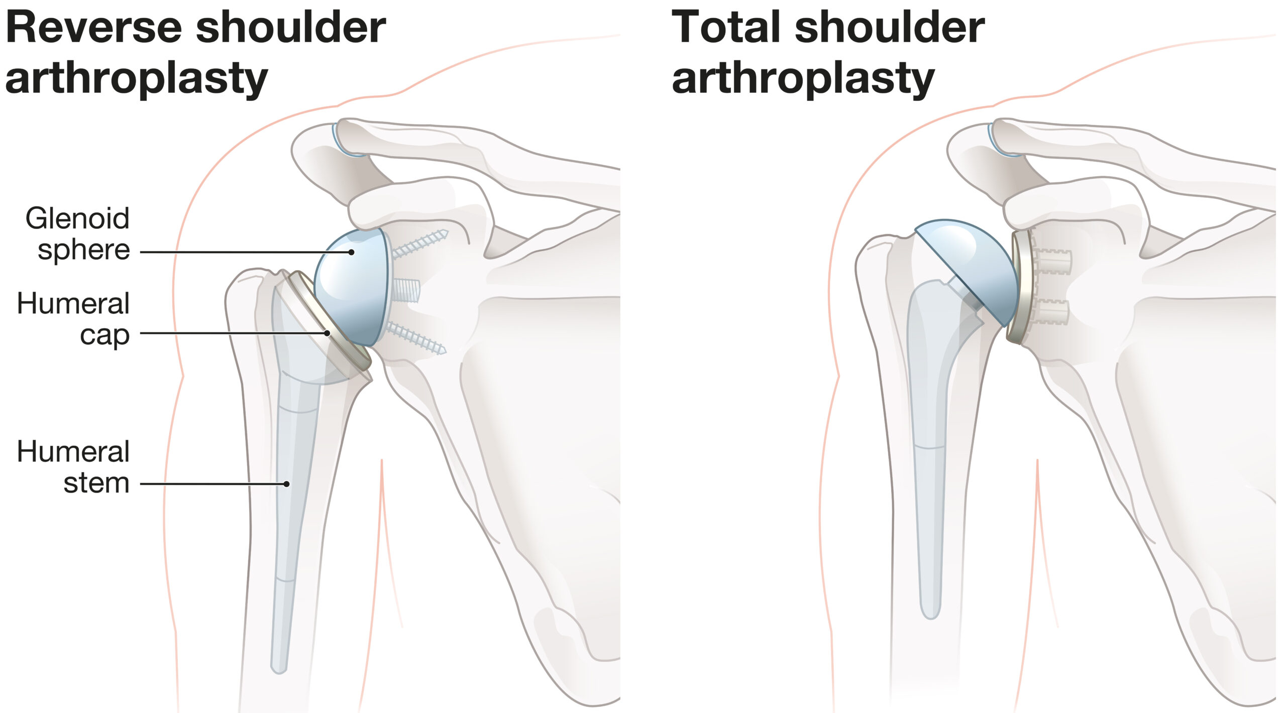 shoulderarthroplasty scaled